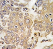 IHC analysis of FFPE human lung carcinoma tissue stained with MAPK4 antibody