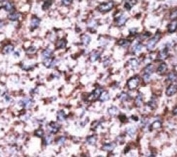 IHC analysis of FFPE human hepatocarcinoma stained with the BACE2C antibody