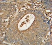 ACOX1 antibody immunohistochemistry analysis in formalin fixed and paraffin embedded human colon carcinoma
