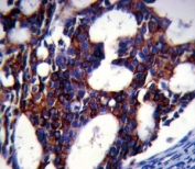 TGFB2 antibody analysis in formalin fixed and paraffin embedded human breast carcinoma.