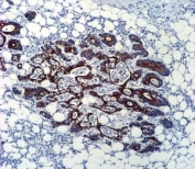 TGFB2 antibody immunohsitochemistry analysis in formalin fixed and paraffin embedded human colon carcinoma