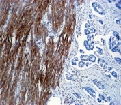 Skeletal muscle Actin antibody immunohistochemistry analysis in formalin fixed and paraffin embedded human colon carcinoma.