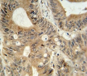 ABCC3 antibody immunohistochemistry analysis in formalin fixed and paraffin embedded human colon carcinoma.