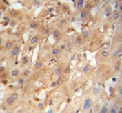 NEU4 antibody immunohistochemistry analysis in formalin fixed and paraffin embedded human hepatocarcinoma.