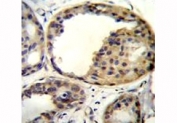 AKT1 antibody immunohistochemistry analysis in formalin fixed and paraffin embedded human breast carcinoma