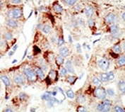 IHC analysis of FFPE human hepatocarcinoma stained with the Dnmt2 antibody