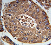 ACN9 antibody immunohistochemistry analysis in formalin fixed and paraffin embedded human hepatocarcinoma.