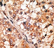 IHC analysis of FFPE human hepatocarcinoma tissue stained with the Bim antibody