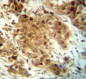 FOXO3 antibody immunohistochemistry analysis in formalin fixed and paraffin embedded human breast carcinoma.