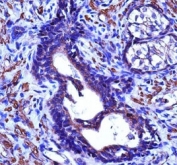 ACTG2 antibody immunohistochemistry analysis in formalin fixed and paraffin embedded human prostate cancinoma.