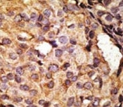 IHC analysis of FFPE human breast carcinoma tissue stained with the TLR6 antibody