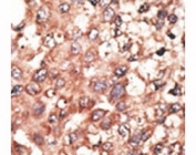 IHC analysis of FFPE human hepatocarcinoma tissue stained with the BMP5 antibody