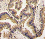 IHC analysis of FFPE human lung carcinoma tissue stained with BMP6 antibody