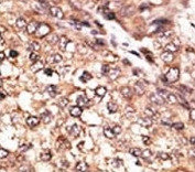 IHC analysis of FFPE human hepatocarcinoma tissue stained with the BMP7 antibody