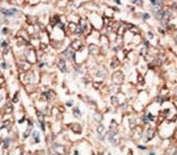 IHC analysis of FFPE human hepatocarcinoma tissue stained with the BMPR1A antibody