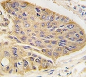 IHC analysis of FFPE human lung carcinoma tissue stained with anti-MAP2 antibody