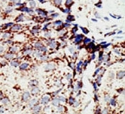 IHC analysis of FFPE human breast carcinoma tissue stained with the BAP1 antibody