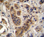ACOX1 antibody analysis in formalin fixed and paraffin embedded human bladder carcinoma.