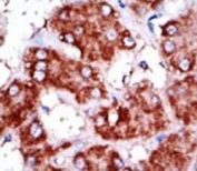 IHC analysis of FFPE human hepatocarcinoma tissue stained with the CPT1B antibody