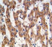 IHC analysis of FFPE human hepatocarcinoma tissue stained with PHB antibody