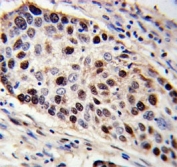 PCNA antibody immunohistochemistry analysis in formalin fixed and paraffin embedded human lung carcinoma.