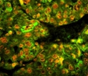 Immunofluorescence analysis of CD38 antibody with paraffin-embedded human hepatocarcinoma tissue. Primary Ab was followed by FITC-conjugated goat anti-rabbit lgG. FITC emits green fluorescence. Red counterstaining is PI.