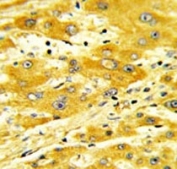 IHC analysis of FFPE human hepatocarcinoma with CD36 antibody