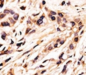 IHC analysis of FFPE human breast carcinoma tissue stained with the phospho-Rb antibody.