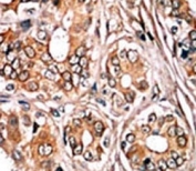 IHC analysis of FFPE human breast carcinoma tissue stained with the phospho-Rb antibody.