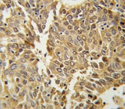 HIF1 alpha antibody IHC analysis in formalin fixed and paraffin embedded lung carcinoma.