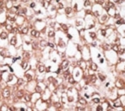 IHC analysis of FFPE human hepatocarcinoma tissue stained with the ABCB11 antibody