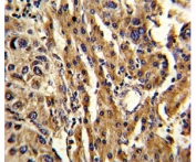 IHC analysis of FFPE human hepatocarcinoma stained with ABCG1 antibody