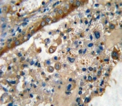 IHC analysis of FFPE human lung carcinoma stained with GARP antibody