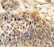 IHC analysis of FFPE human bladder carcinoma stained with WNT4 antibody