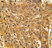 IHC analysis of FFPE human lung carcinoma with Fascin antibody