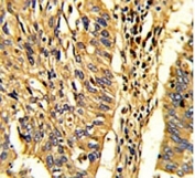 IHC analysis of FFPE human lung carcinoma with HSP60 antibody.