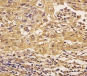 IHC testing of FFPE human cervical cancer with ASS1 antibody at 1:25 dilution. HIER: boil tissue sections in pH6, 10mM citrate buffer, for 10-20 min followed by cooling at RT for 20 min.