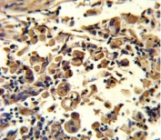 IHC analysis of FFPE human lung carcinoma stained with SOD3 antibody