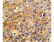 IHC analysis of FFPE human hepatocarcinoma with Cyclin A2 antibody
