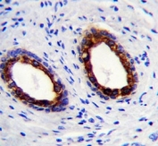 Cytokeratin-18 antibody immunohistochemistry analysis in formalin fixed and paraffin embedded human prostate carcinoma.