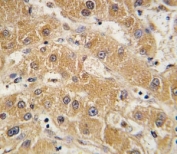 IHC analysis of FFPE human hepatocarcinoma tissue stained with APOA5 antibody.