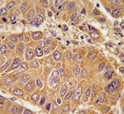 IHC analysis of FFPE human hepatocarcinoma tissue stained with APOA1 antibody