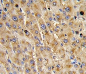 IHC analysis of FFPE human hepatocarcinoma with ADAMTS13 antibody