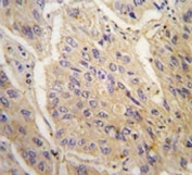 IHC analysis of FFPE human lung carcinoma tissue stained with anti-Caspase-3 antibody