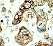 IHC analysis of FFPE human breast carcinoma tissue stained with the EphA2 antibody
