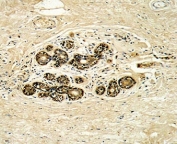 IHC analysis of FFPE human breast carcinoma with HER3 antibody