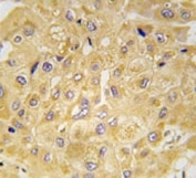 IHC analysis of FFPE human hepatocarcinoma tissue stained with Integrin linked kinase antibody