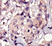 IHC analysis of FFPE human breast carcinoma tissue stained with PDGFRA antibody