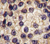 IHC analysis of FFPE human prostate carcinoma tissue stained with PDGFR alpha antibody