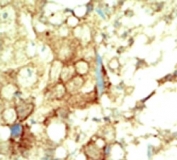 IHC analysis of FFPE human breast carcinoma tissue stained with the RET antibody